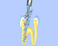 ENAC tips for root canal treatment