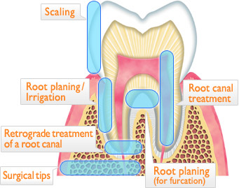 ENAC tip - cut section